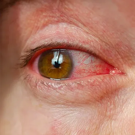 Close-up of an irritated, red eye.